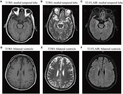 Frontiers Case Report Successful Treatment Of An Anti D R And Dppx Antibody Associated